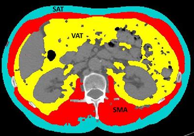 Computed Tomography–Based Body Composition in Patients With Ovarian Cancer: Association With Chemotoxicity and Prognosis